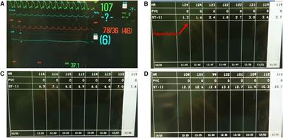 A 7-month-old girl with a suspected air embolism complication during a living-donor liver transplantation procedure: a case report